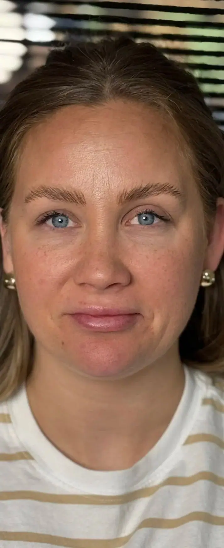 Full Face Lift, after