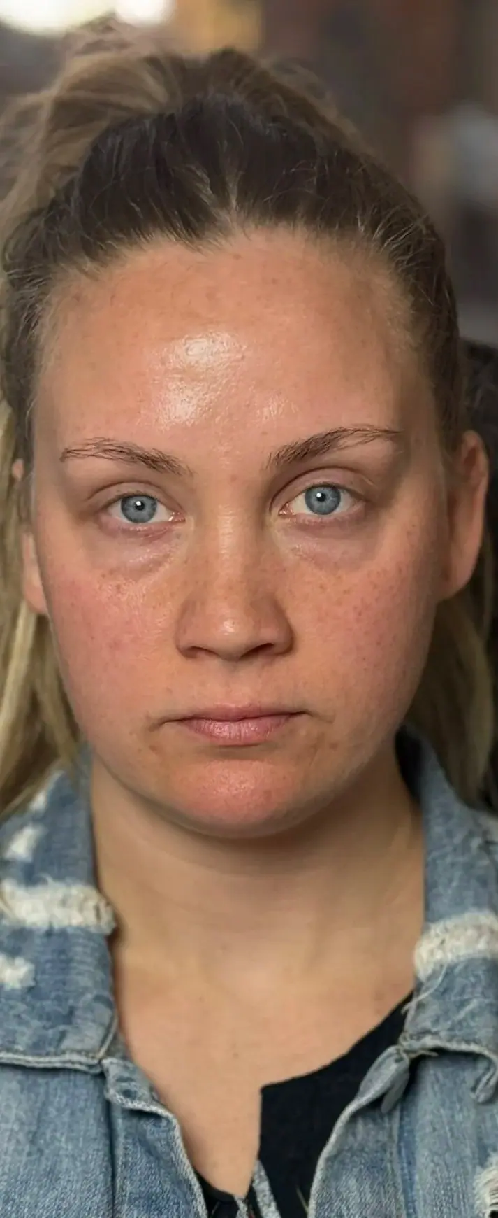 Full Face Lift, before