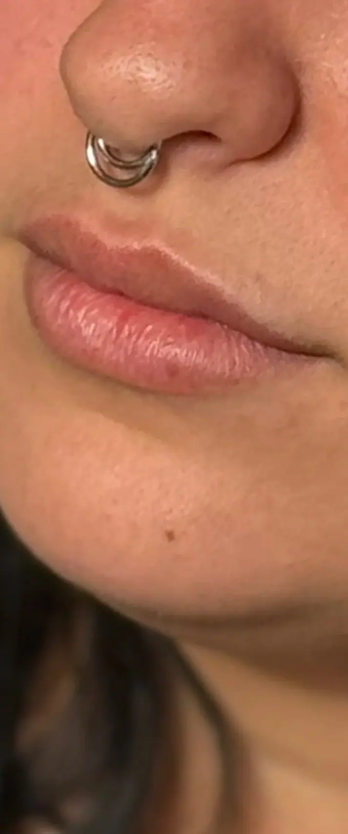 Lip Filler, before
