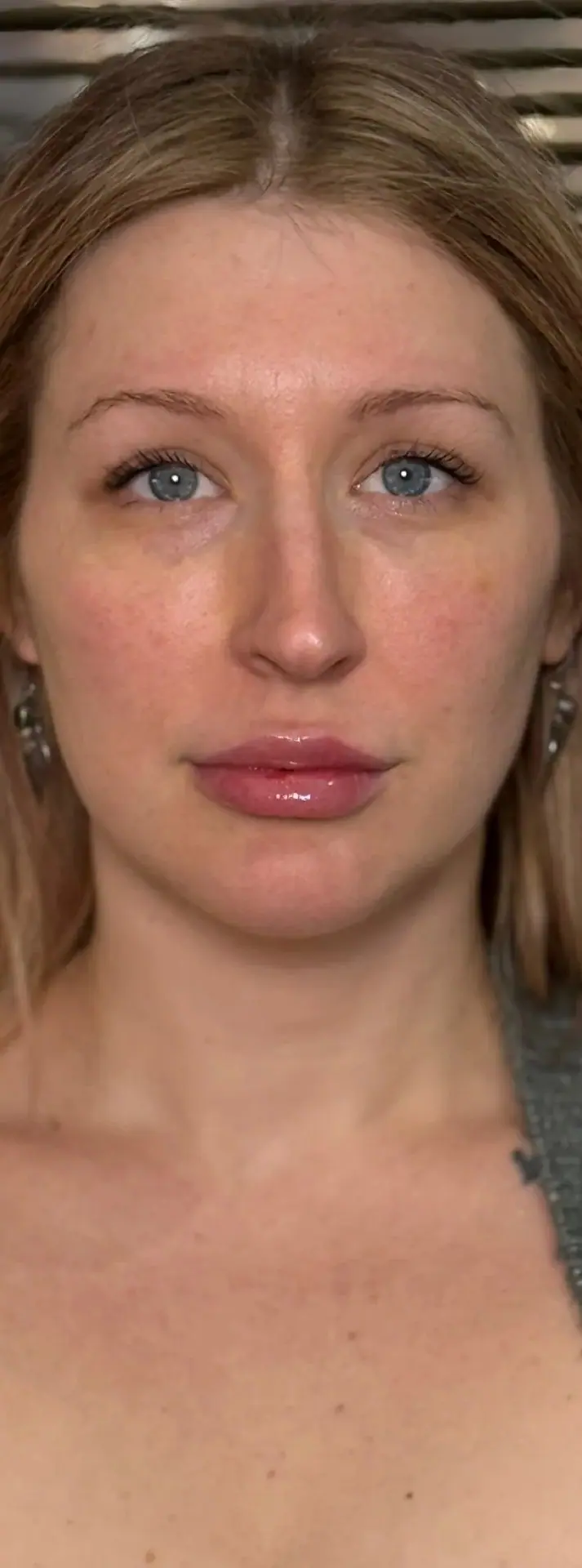 Mini Face Lift, after