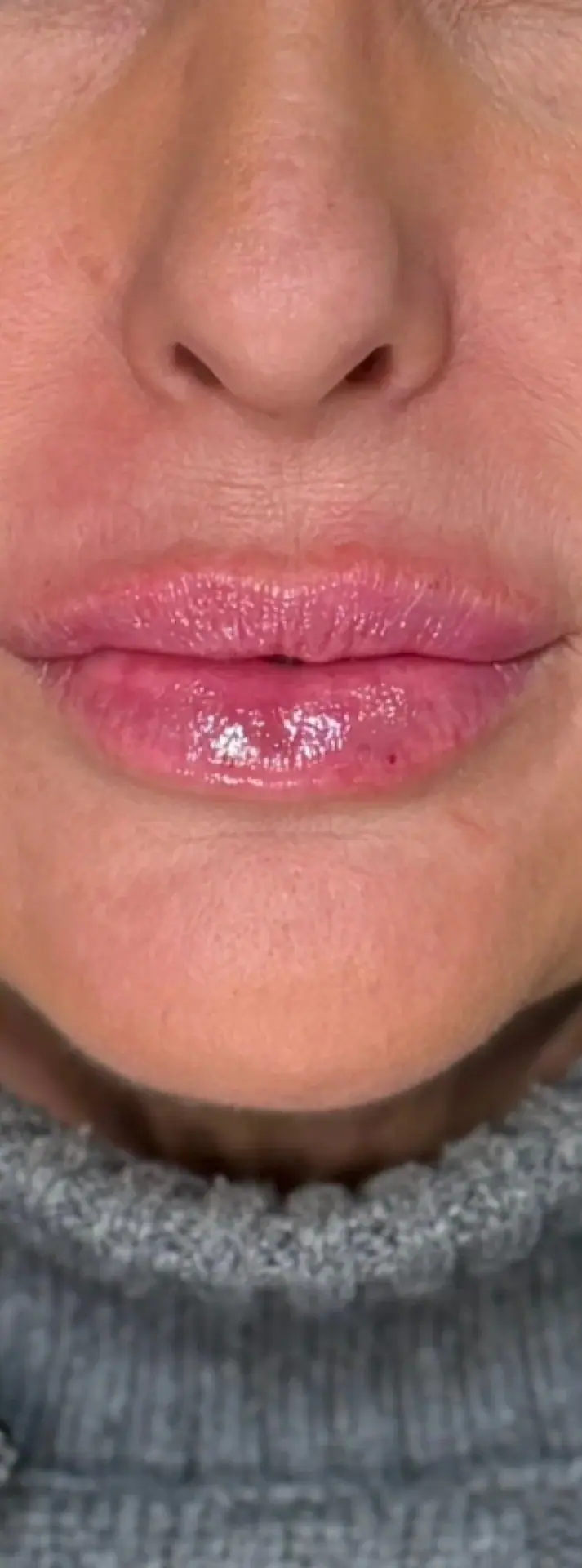 Lip Filler, after
