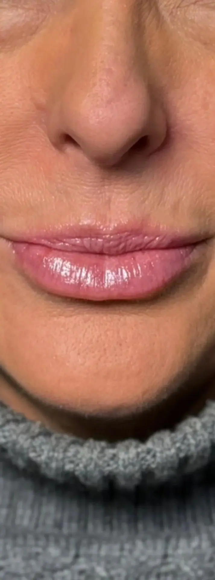 Lip Filler, before