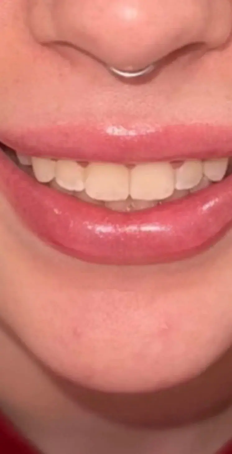 Gummy Smile Treatment, after