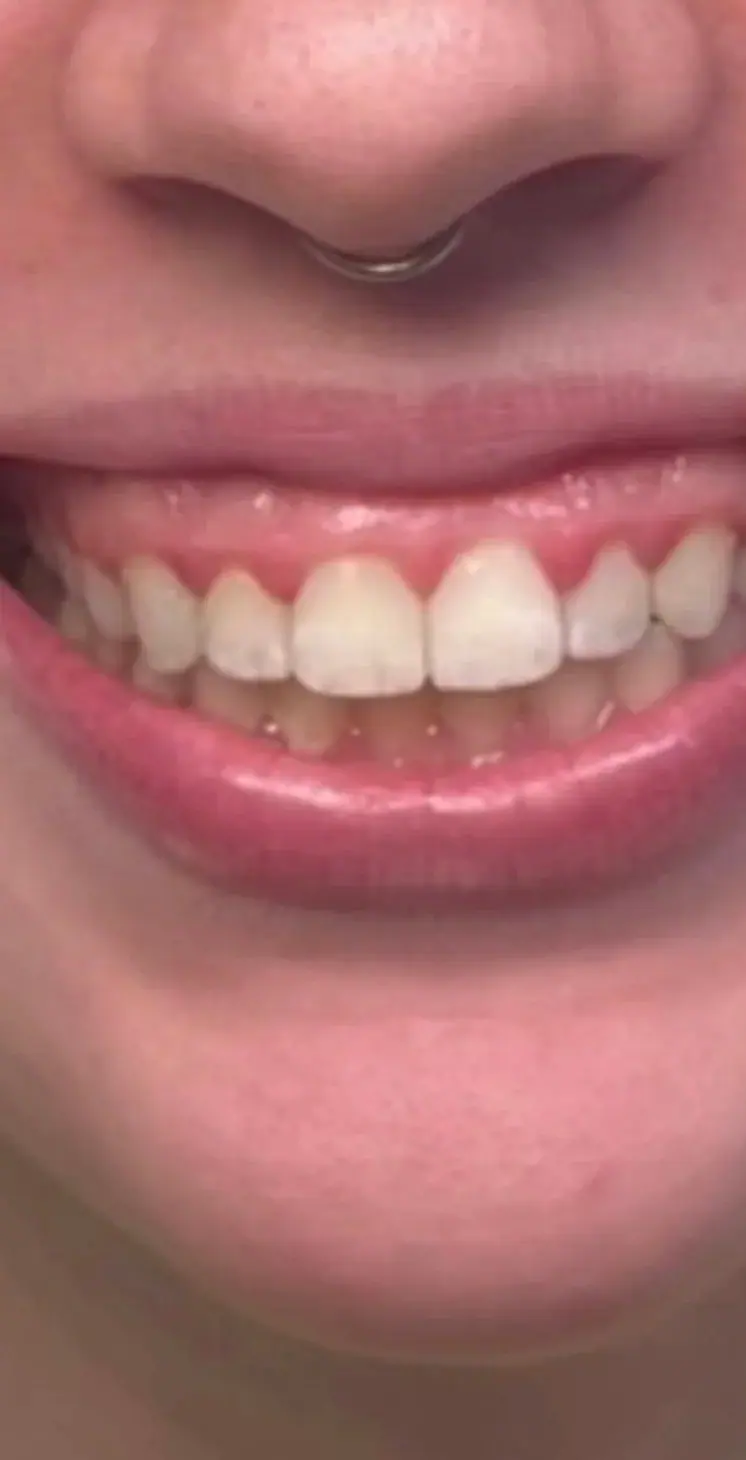 Gummy Smile Treatment, before