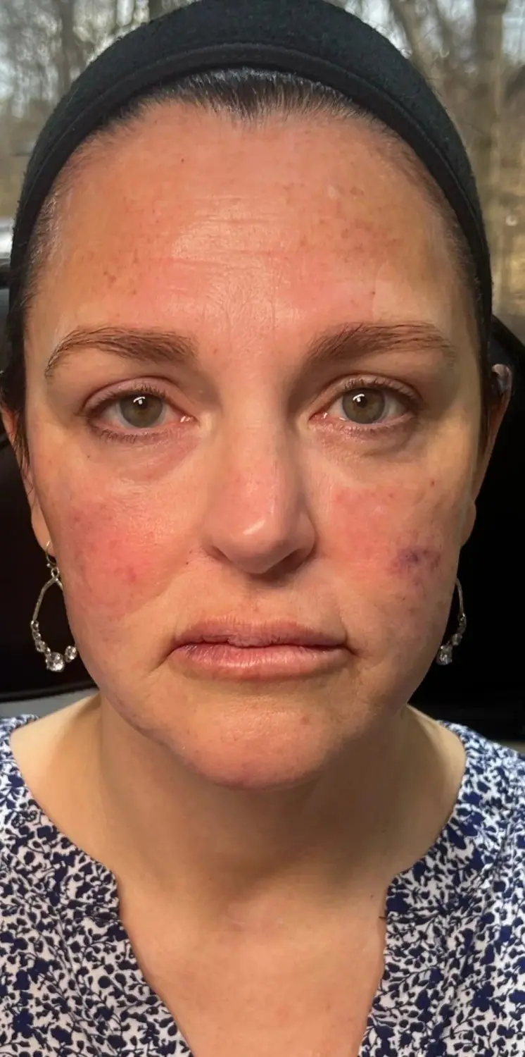 Full Face Lift, after