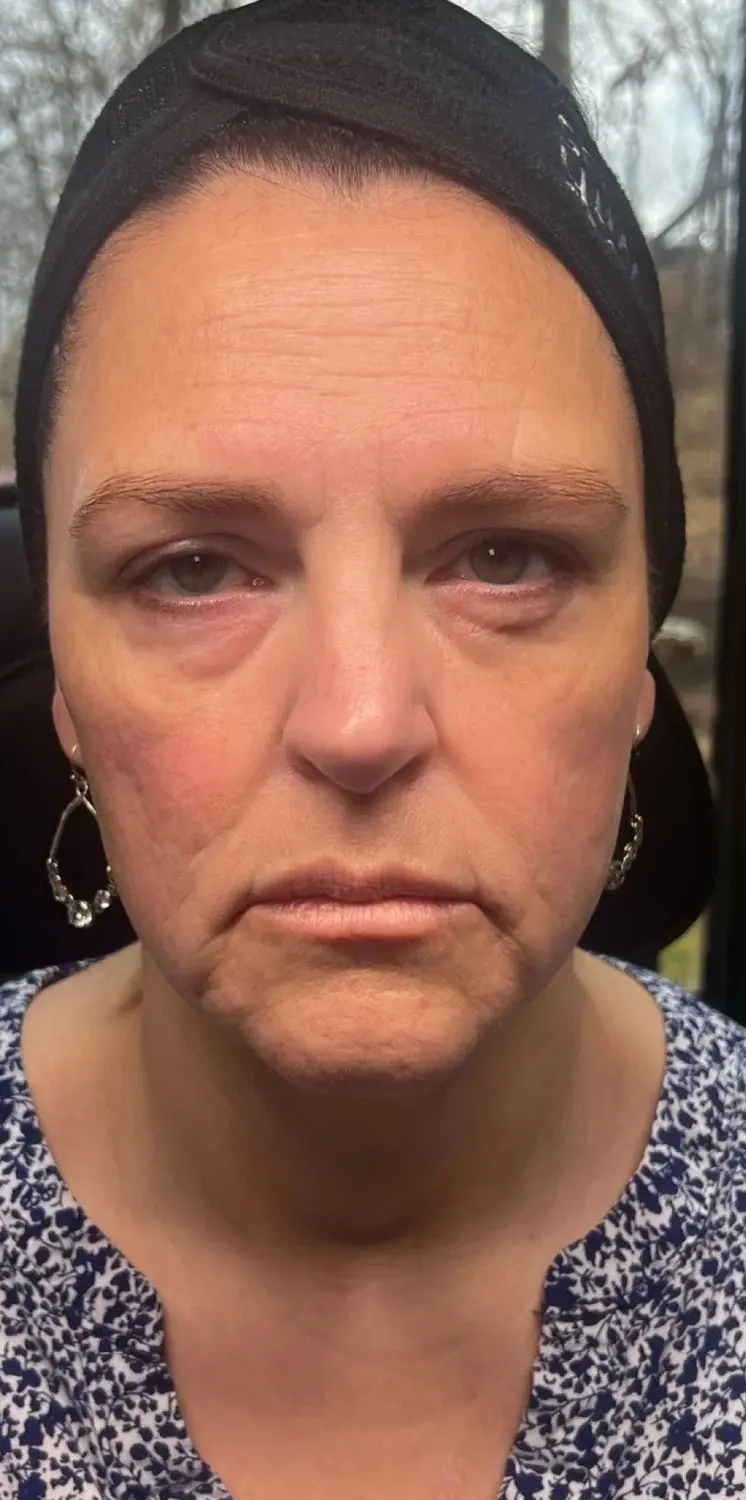 Full Face Lift, before