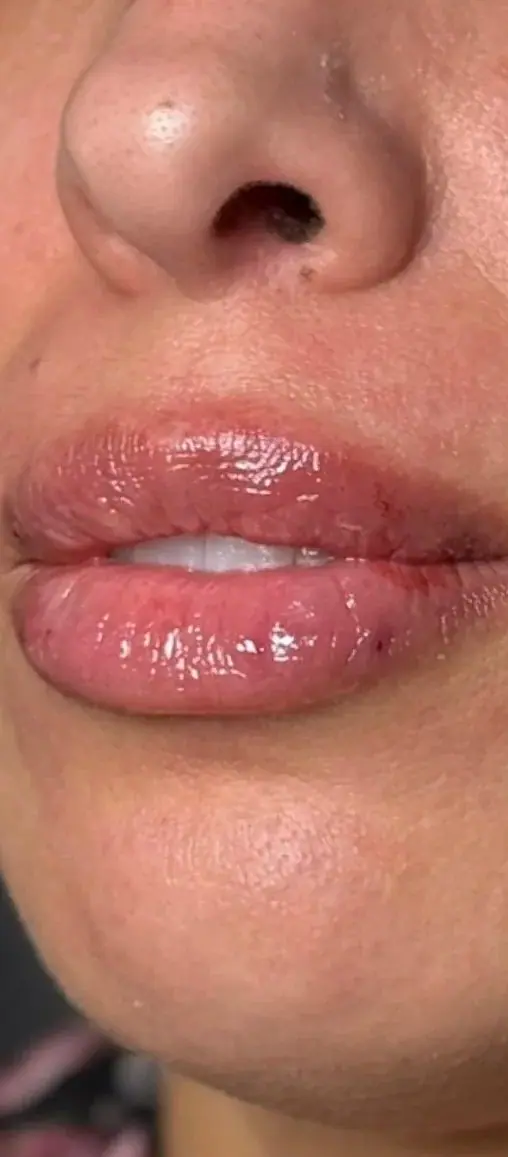 Lip Filler, after