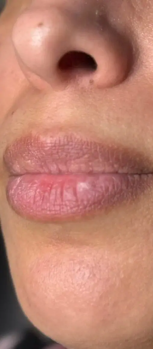 Lip Filler, before