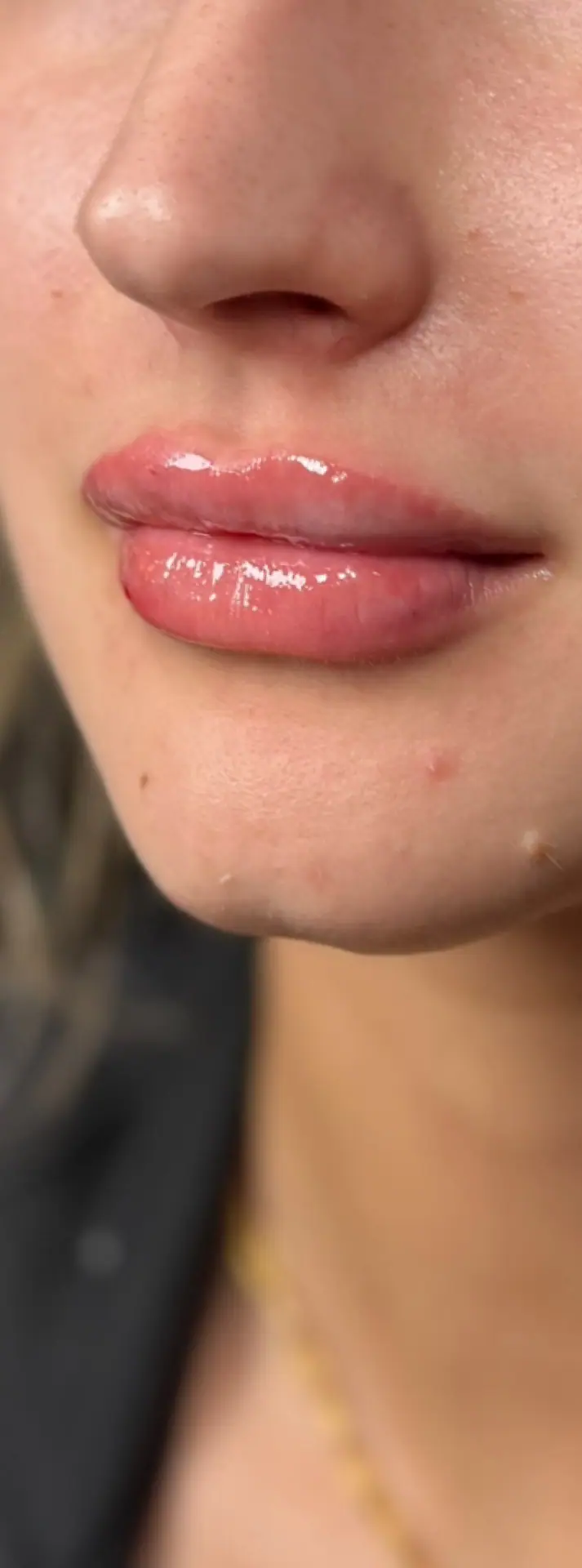 Lip Filler, after