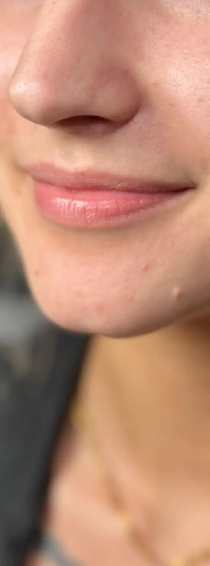 Lip Filler, before