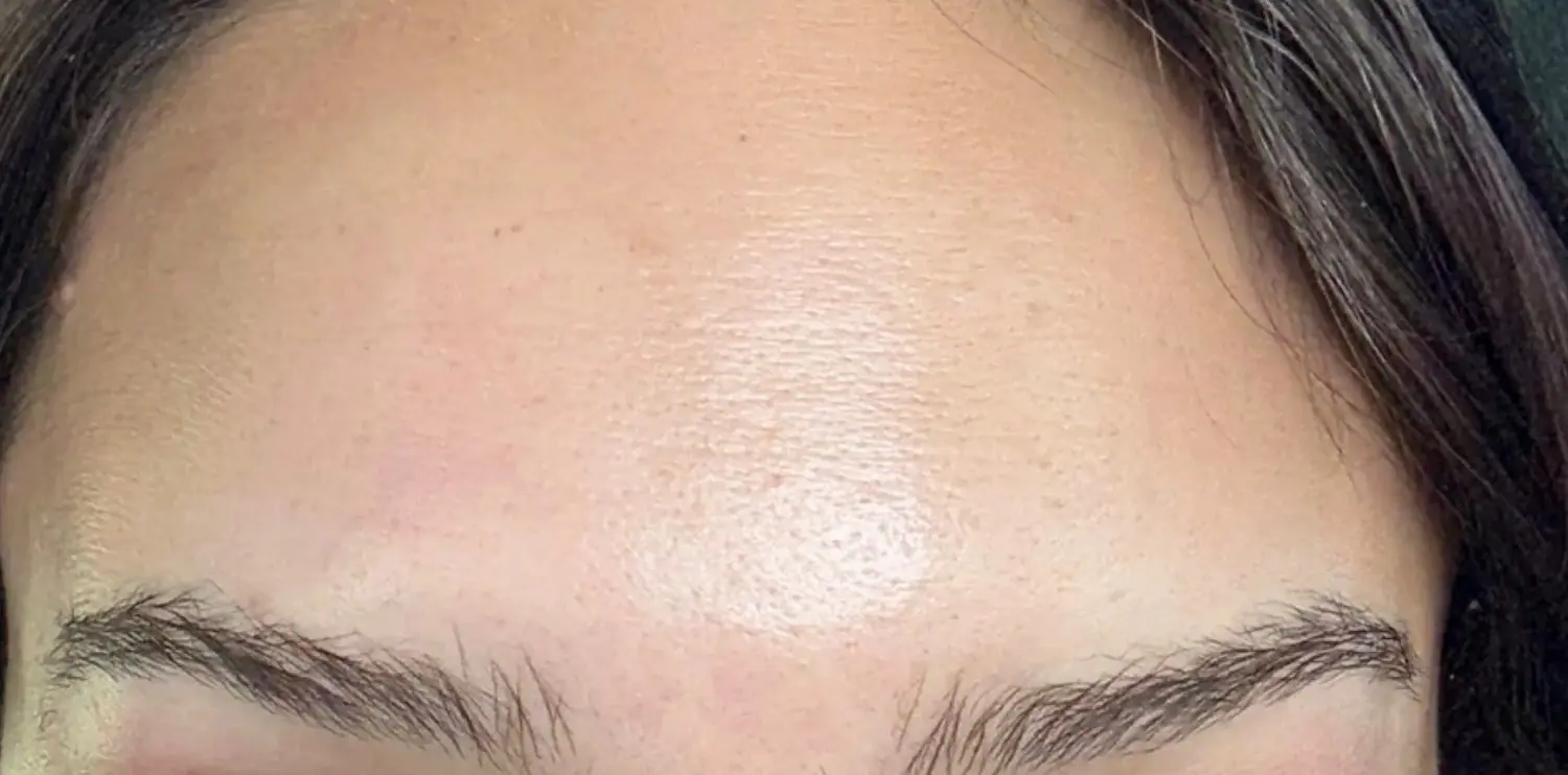 Letybo Neurotoxin, after