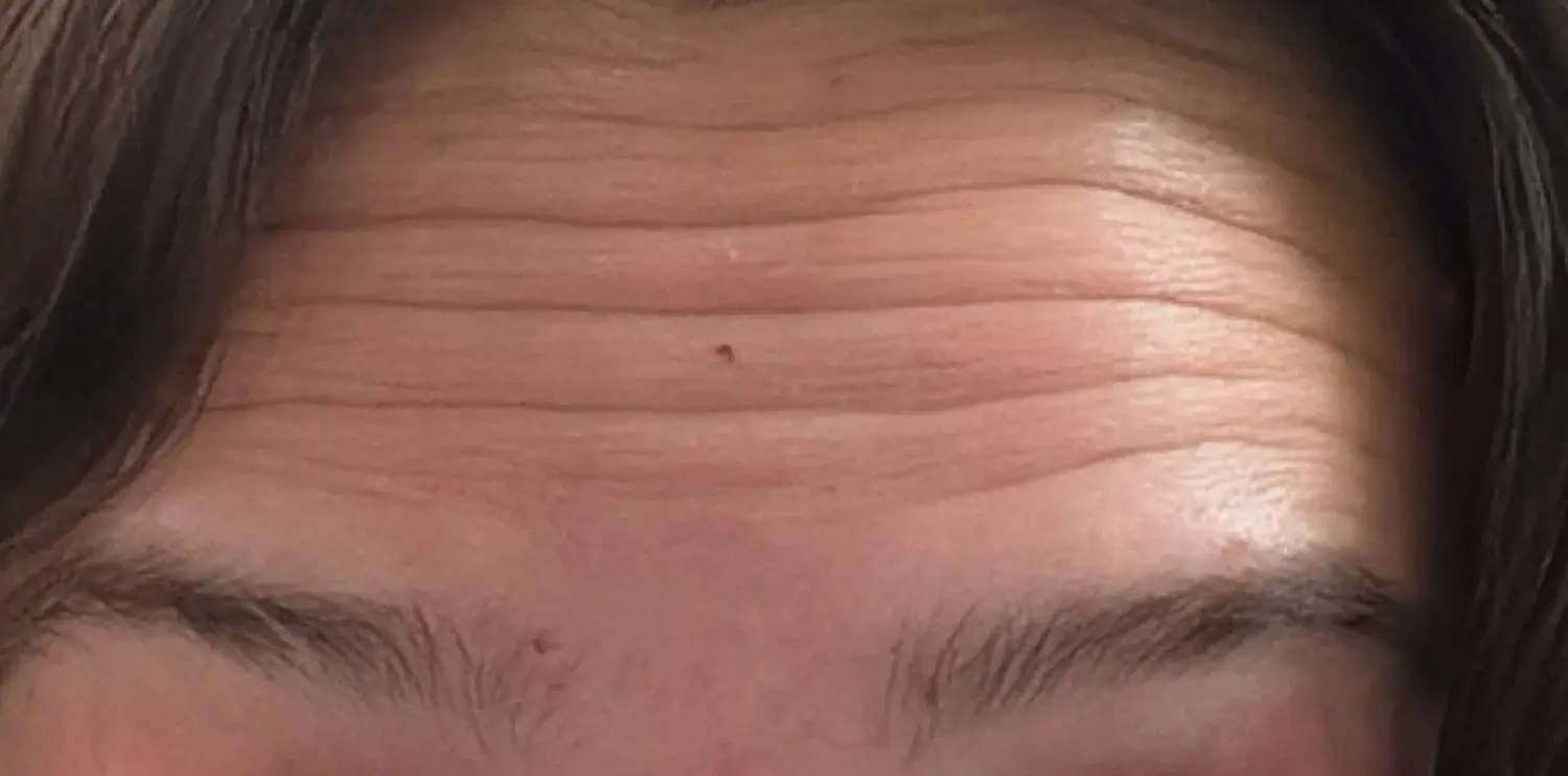 Letybo Neurotoxin, before