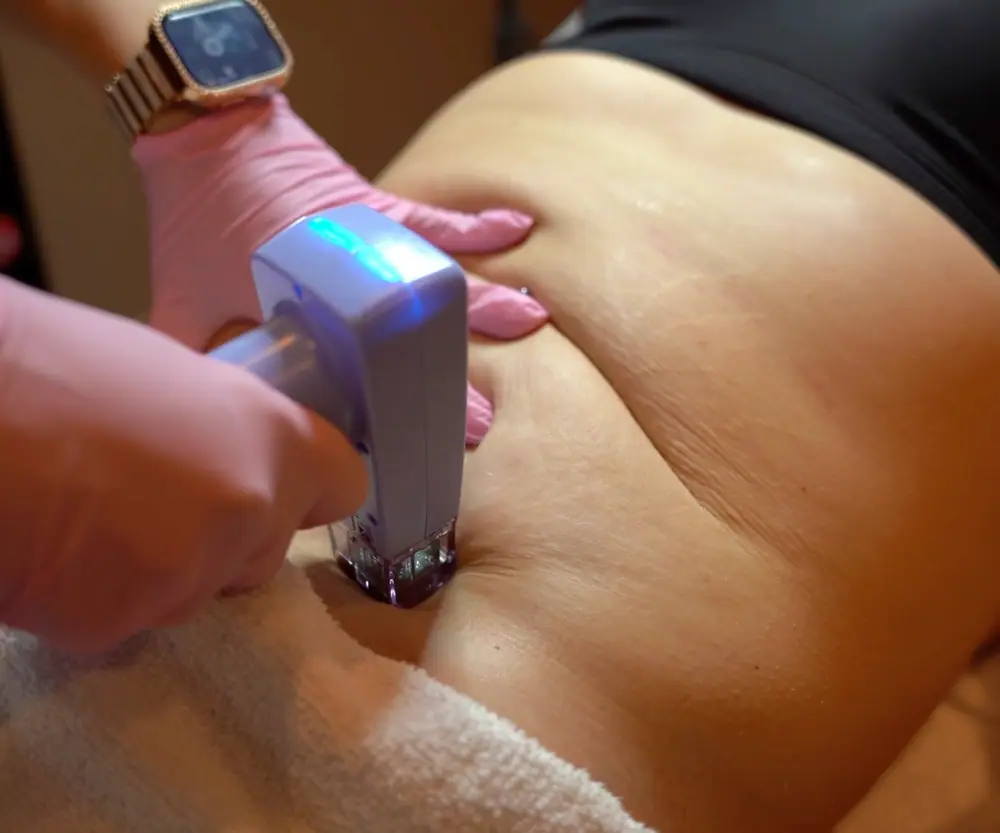 A Morpheus8 handpiece being used during a body treatment