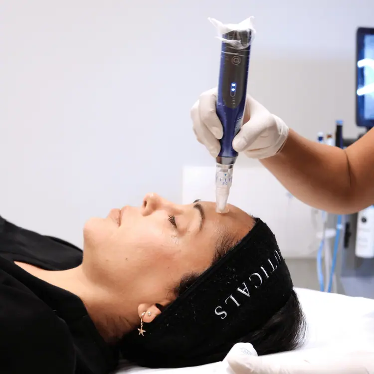 SkinPen microneedling device being used on a client’s forehead